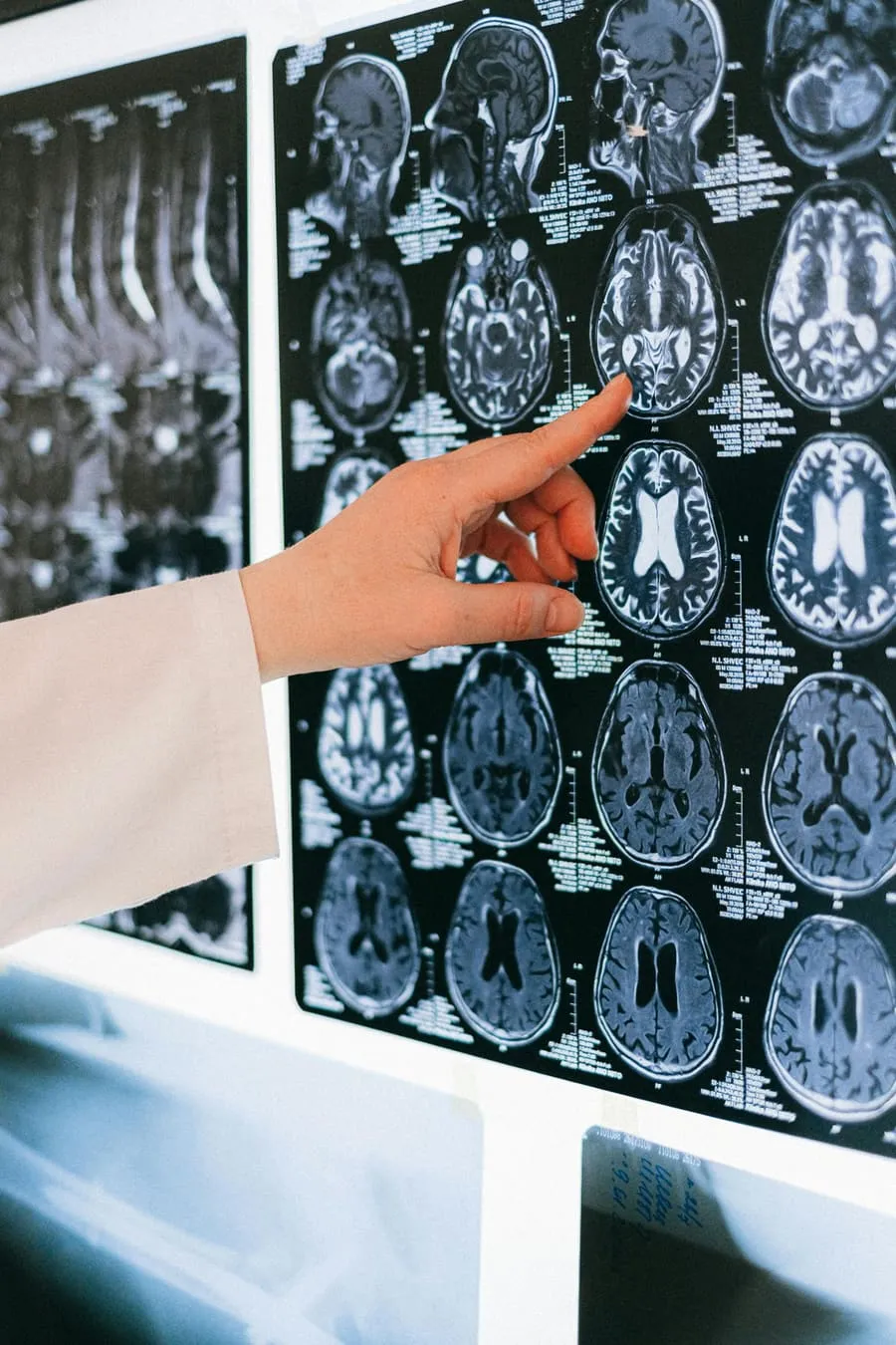 Brain MRI scans displayed side by side on a radiology light box